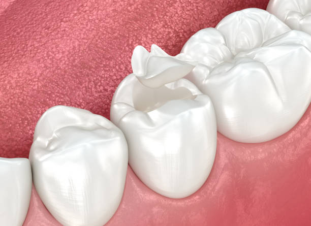 Best Dental Inlays and Onlays  in Pioneer Village, KY